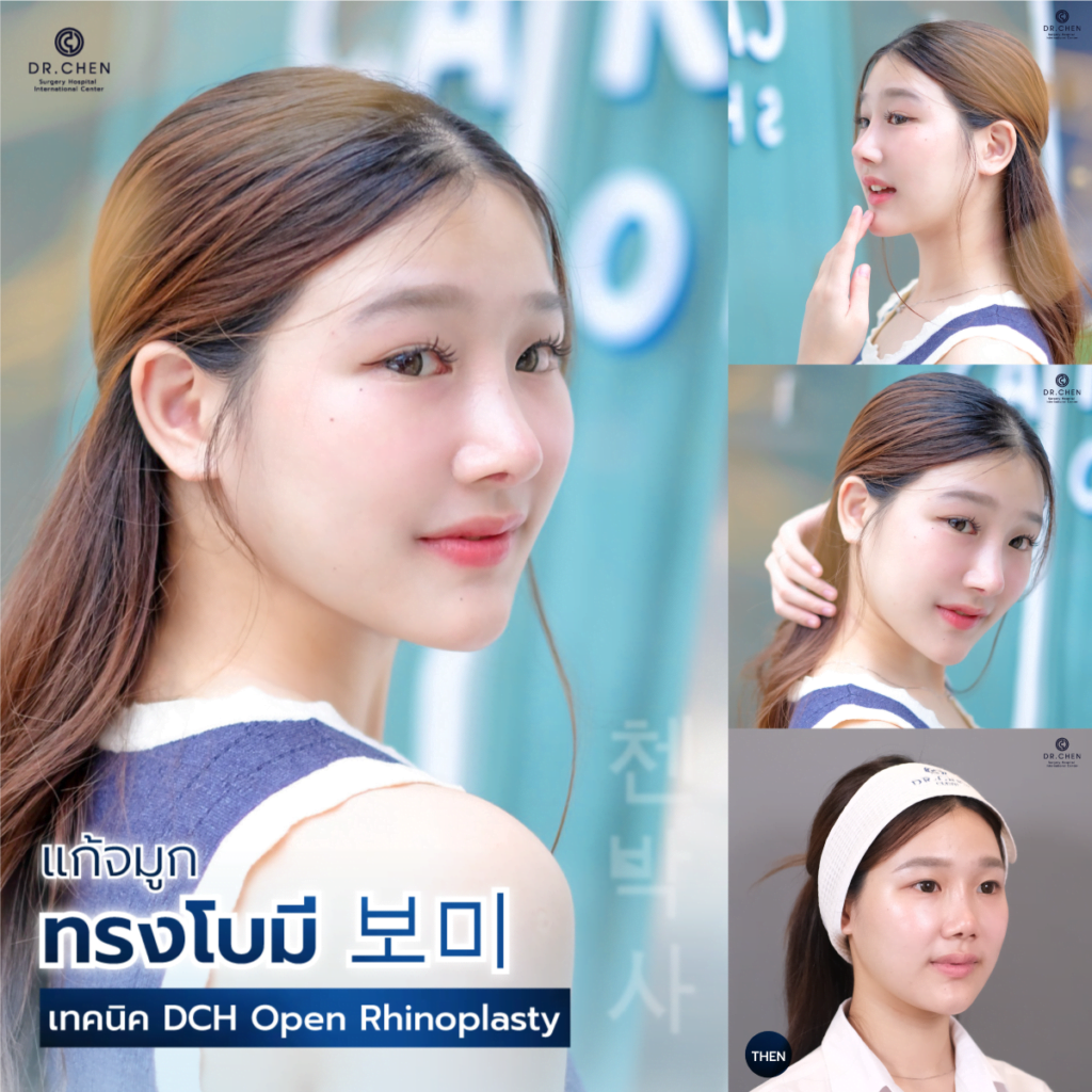 dch open rhinoplasty เสริมจมูกปลายไร้ซิลิโคน ทรงจมูกโบมี 보미 คุณเฟียส