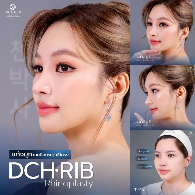 dch open rhinoplasty เสริมจมูกปลายไร้ซิลิโคน คุณโบว์