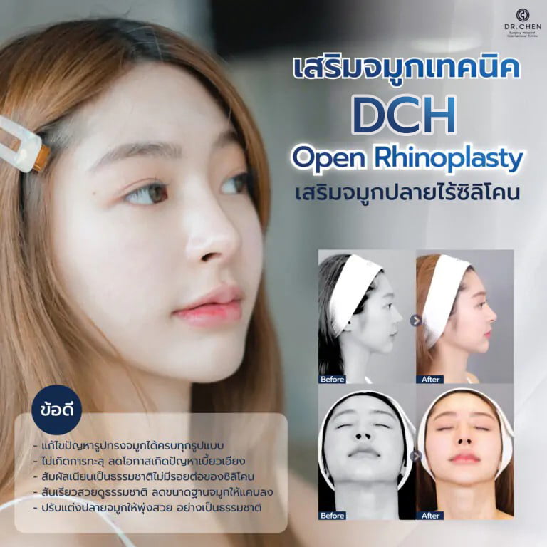 dch open rhinoplasty เสริมจมูกปลายไร้ซิลิโคน