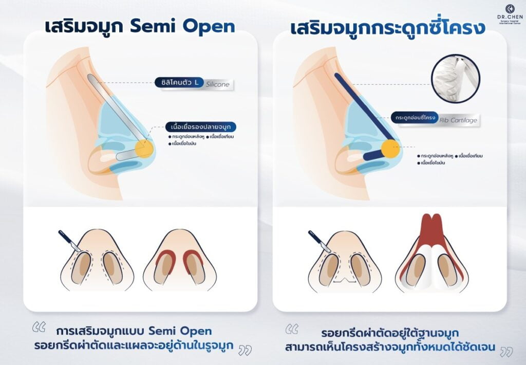 ความแตกต่างระหว่าง DRC Semi Open VS DRC Rib Rhinoplasty