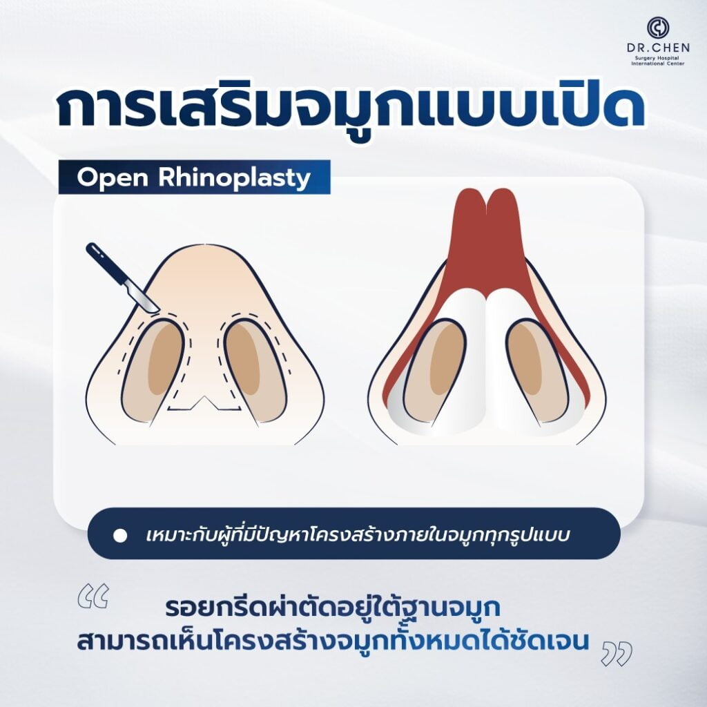 ลักษณะการเปิดแผลจมูกของการทำจมูก open