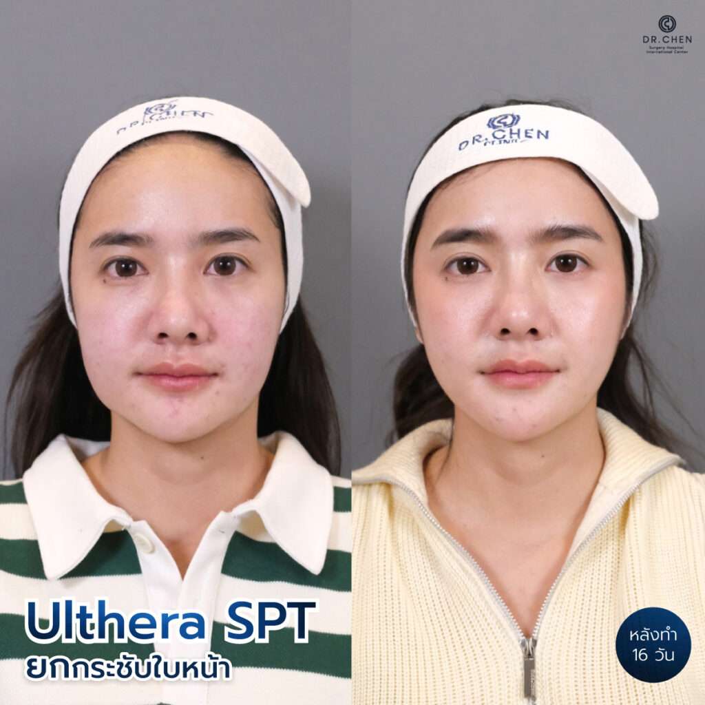 อัลเทร่า ulthera