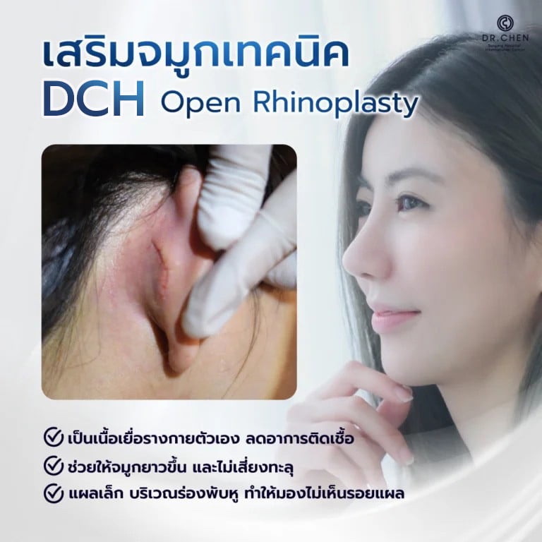เสริมจมูกเทคนิค dch open rhinoplasty