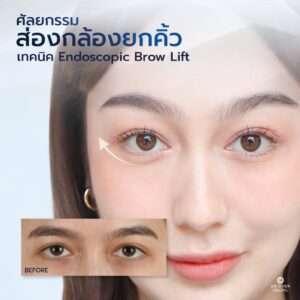 ศัลยกรรมยกหางตา