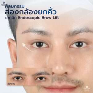 รีวิวศัลยกรรมยกคิ้วผู้ชาย