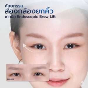ศัลยกรรมยกคิ้วผู้หญิง ตาเฉี่ยว