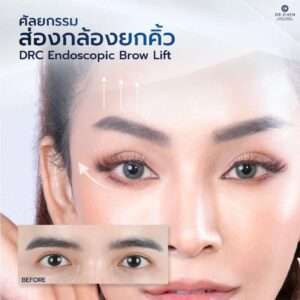 รีวิวศัลยกรรมยกคิ้ว ตาสวย