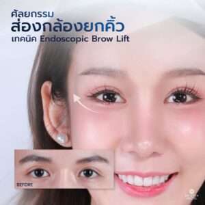 ศัลยกรรมยกคิ้วผู้หญิงตาสดใส