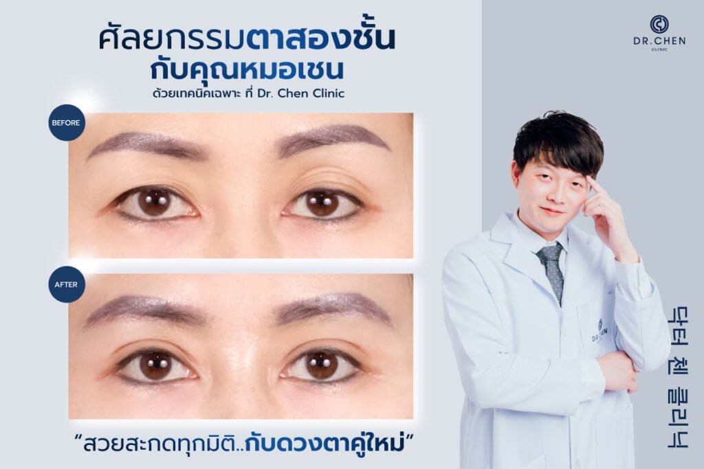 ศัลยกรรมตาสองชั้นกับหมอเชน