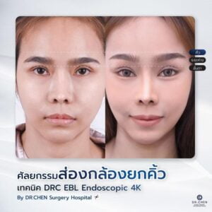 ศัลยกรรมยกคิ้ว