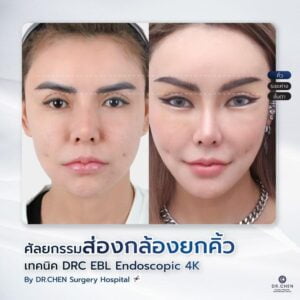 ศัลยกรรมยกคิ้ว