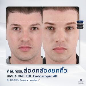 ศัลยกรรมยกคิ้ว