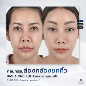 ศัลยกรรมยกคิ้ว