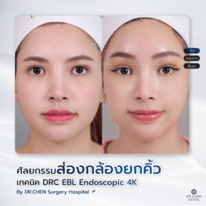 ศัลยกรรมยกคิ้ว