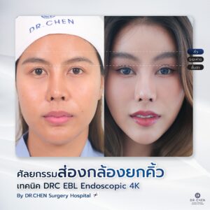 ศัลยกรรมยกคิ้ว