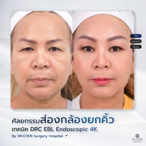 ศัลยกรรมยกคิ้ว