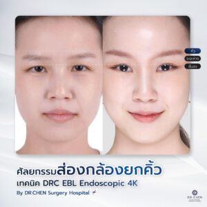 ศัลยกรรมยกคิ้ว