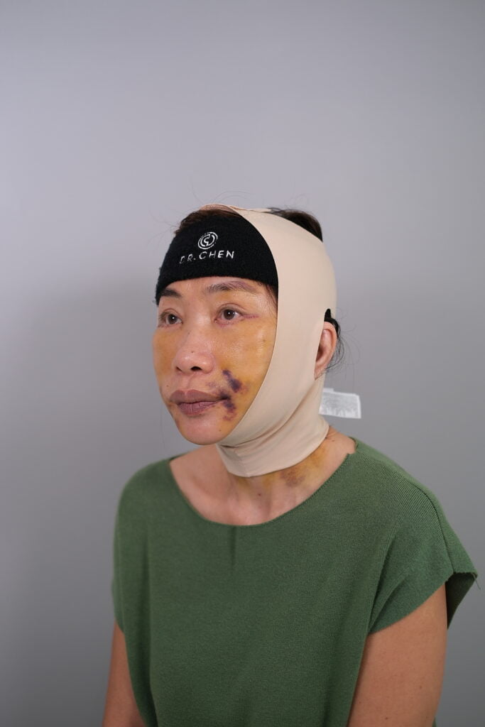 หลังทำ 2 สัปดาห์ ดึงหน้าคุณสุ 1