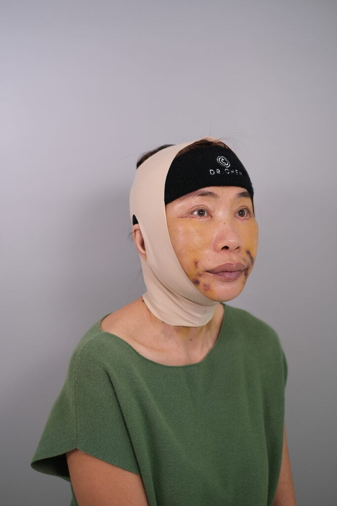 หลังทำ 2 สัปดาห์ ดึงหน้าคุณสุ 2