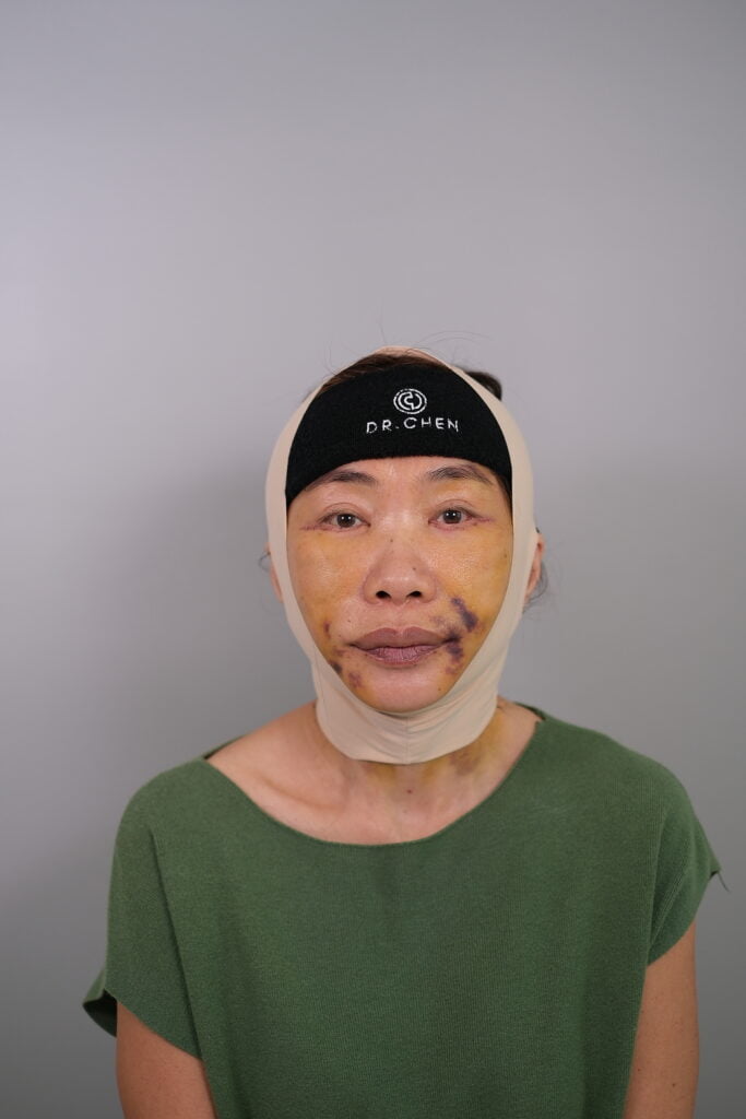 หลังทำ 2 สัปดาห์ ดึงหน้าคุณสุ
