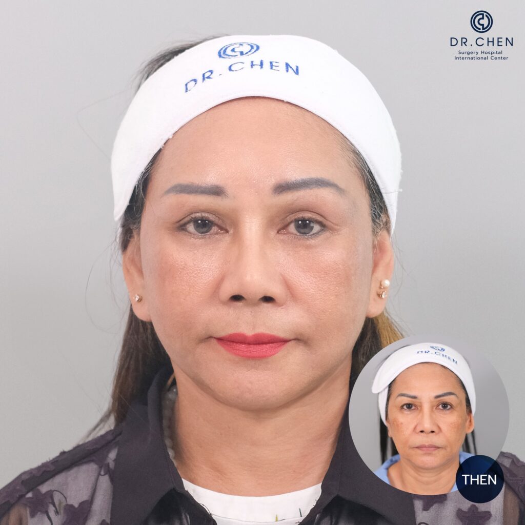 ศัลยกรรมดึงหน้าผู้หญิง