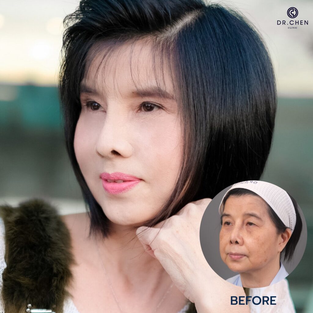 ศัลยกรรมดึงหน้าผู้หญิง