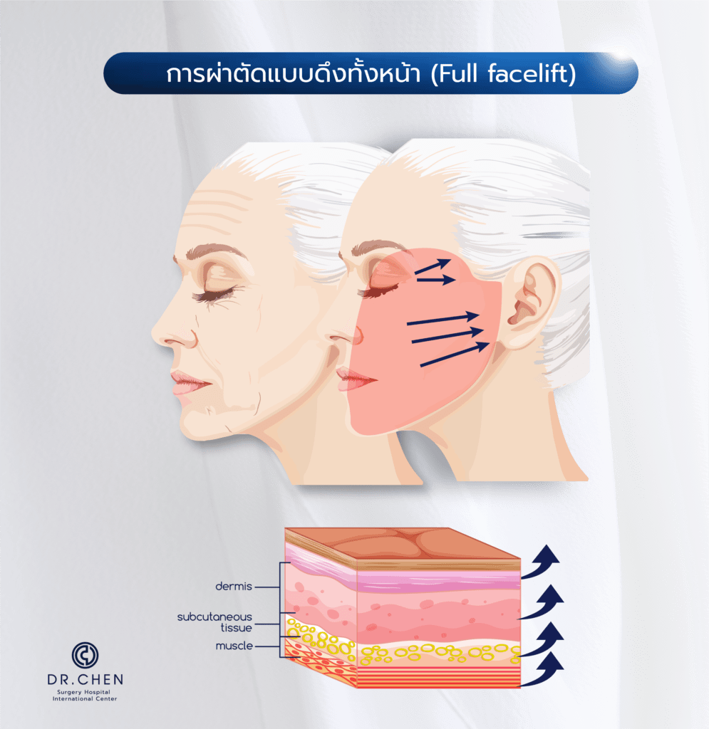 การผ่าตัดแบบดึงทั้งหน้า