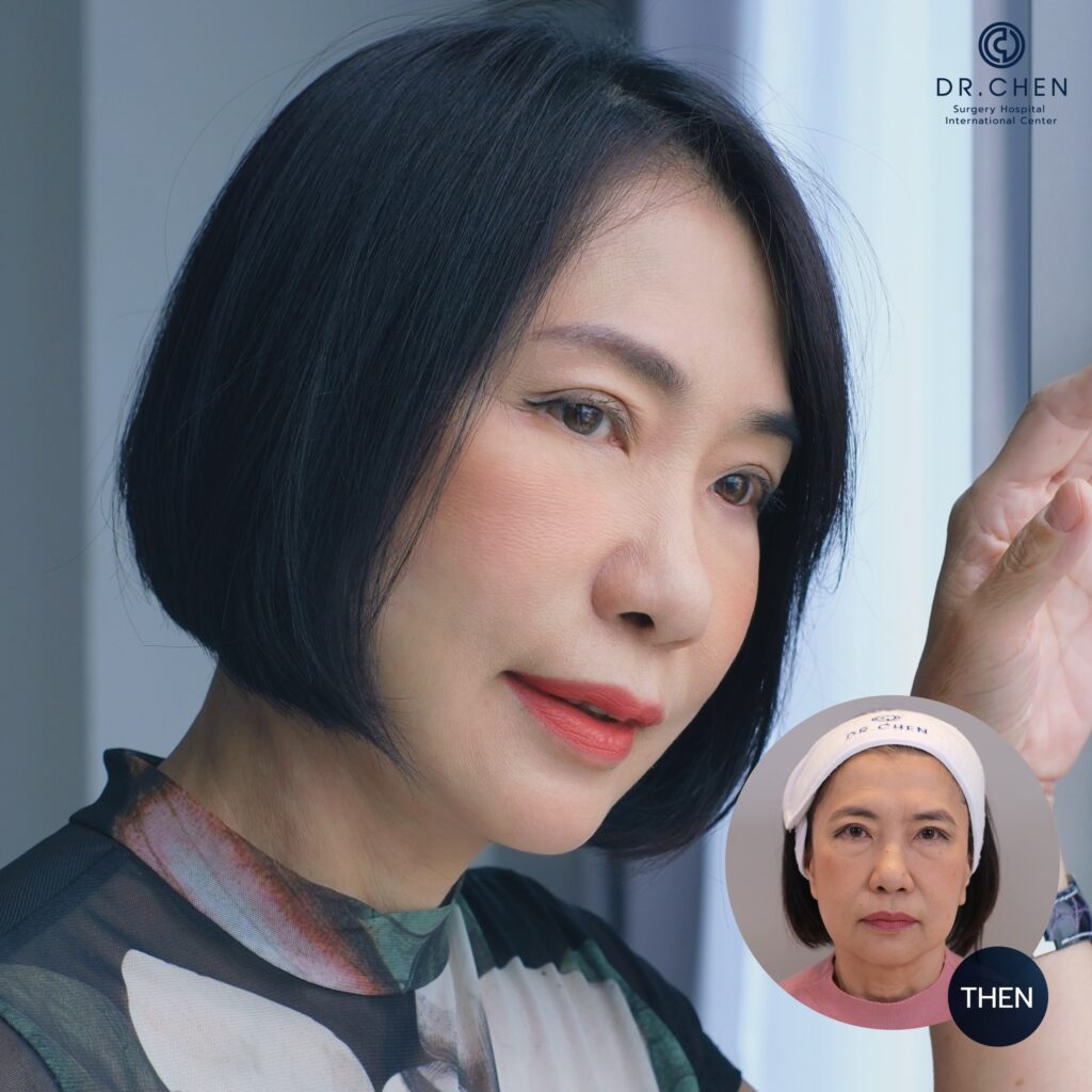 ศัลยกรรมดึงหน้า